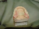 Dentures with duracital frame